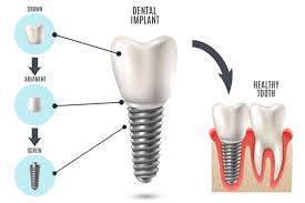 dental implants