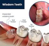 wishdom teeth